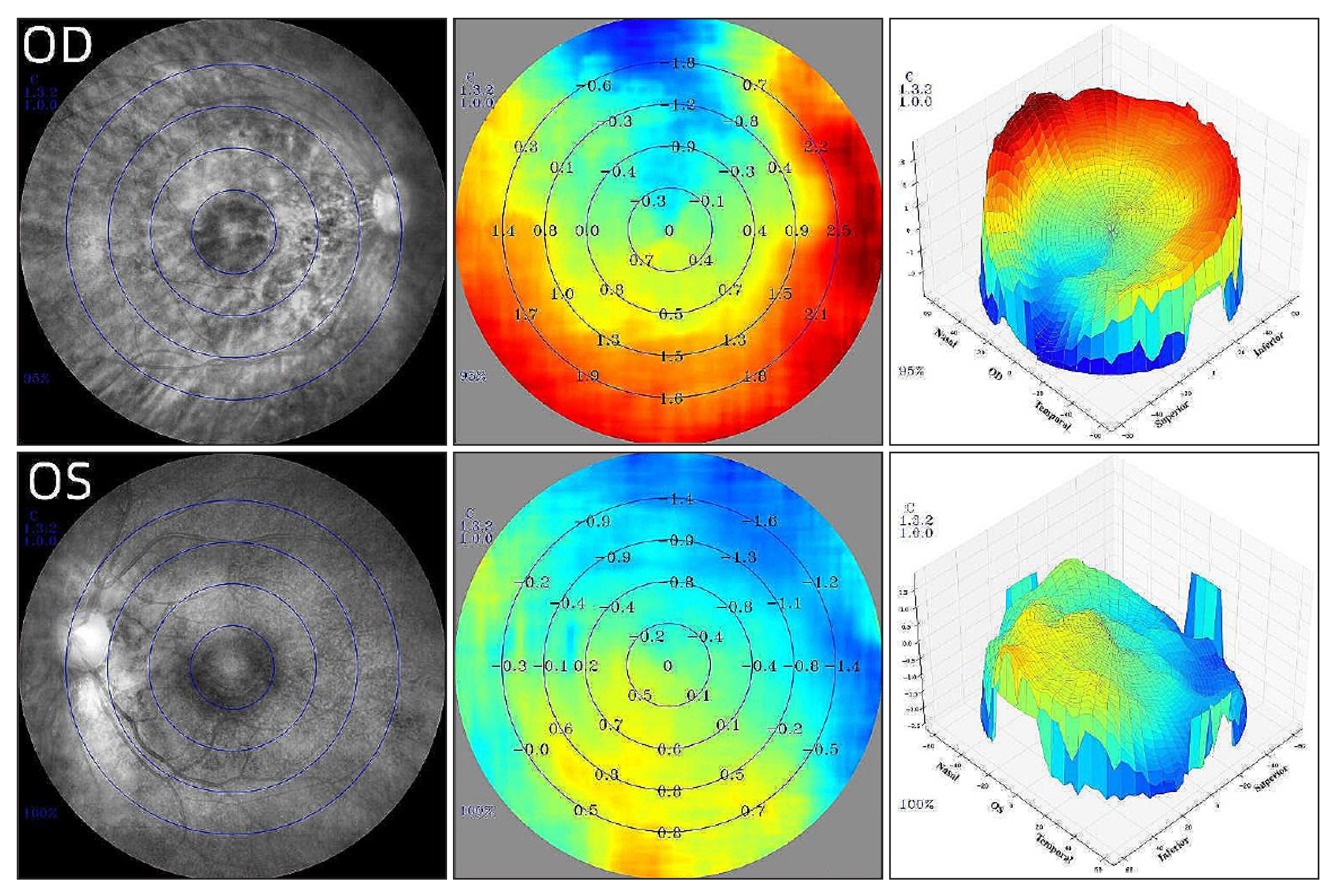 Using multispectral refraction topography, researchers found that eyes with greater myopia exhibited more hyperopic peripheral defocus in the context of anisometropia. Additionally, there were significant differences in defocus values at the inferior and temporal positions between the myopia eyes group and the fellow eyes group. This emerging technology might one day be able to refine the assessment of pediatric myopia and help clinicians tailor a treatment approach to each individual.
