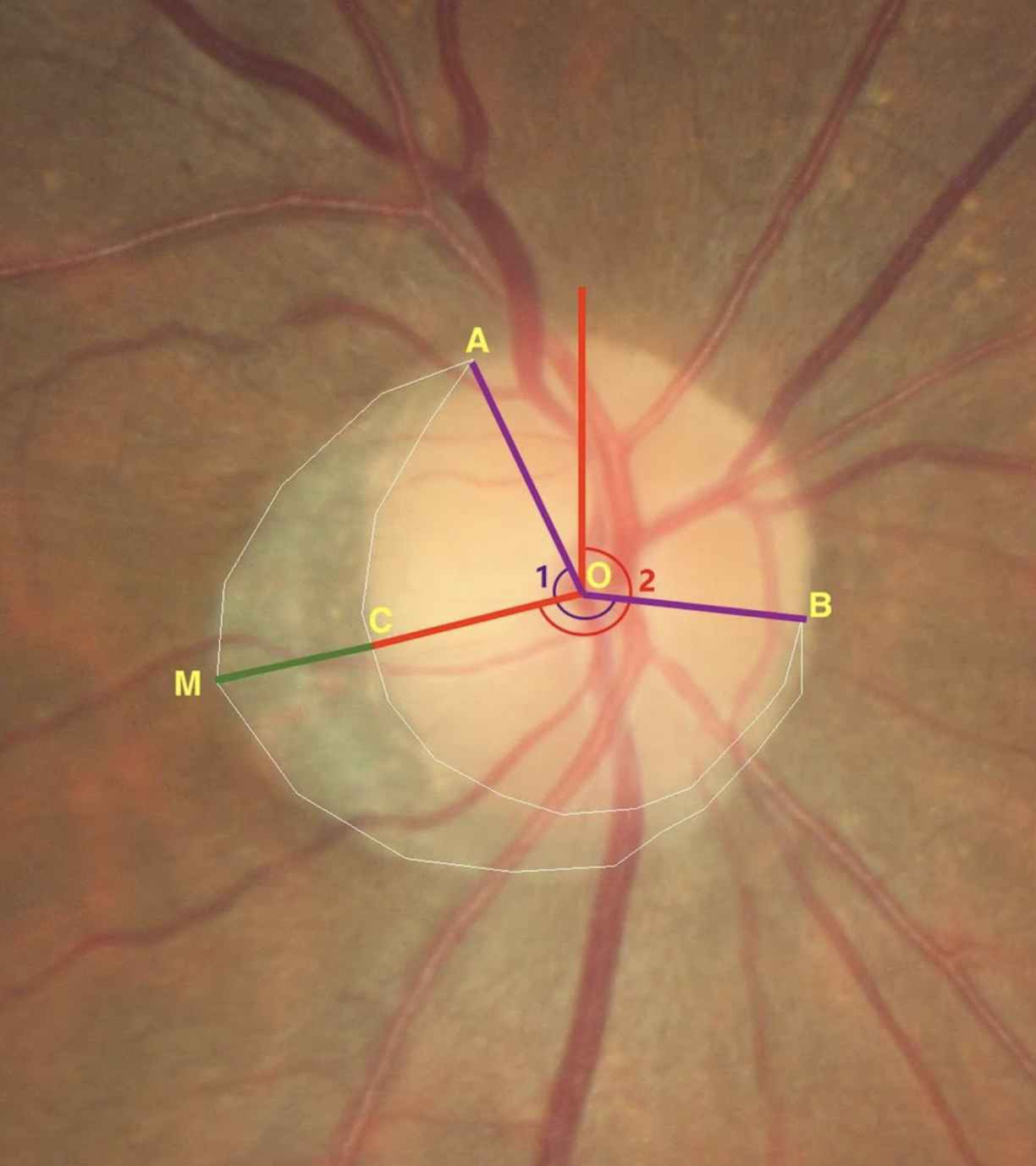 In a retrospective cohort study conducted in South Korea, researchers found longer radial extent and larger angular extent of beta-zone parapapillary atrophy were significantly associated in progression, suggesting this could be a predictive tool used in clinical practice. In this image (from a different study), point O is the center of the disc, and point A and B is the vertices of the beta zone, the point M and C is the maximum radial extent on the beta zone margin and disc margin. The beta zone is the area inside the white line, circumferential angle of the beta zone was defined as the angle between point A and B (angle 1), location of the beta zone was defined as the angle between maximum radial extent and vertical line from the center point of disc (angle 2), distance from C to M was defined as maximum radial extent of the beta zone.
