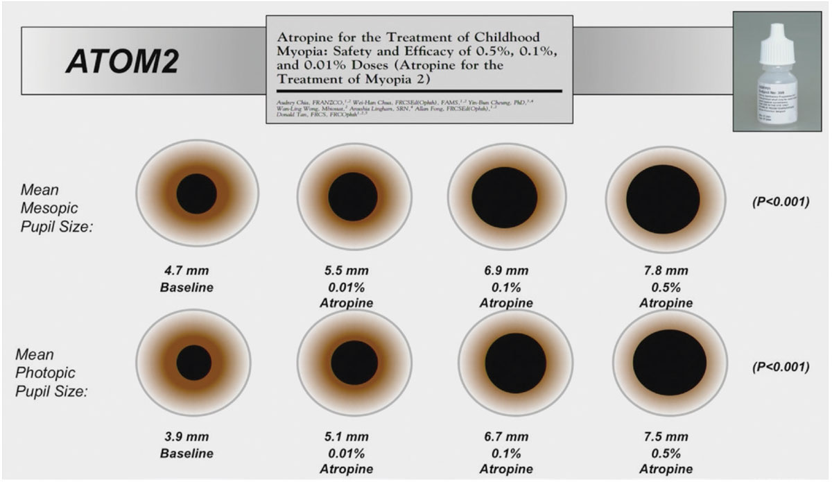 ATOM2 used lower concentrations of atropine to minimize side effects, including pupil dilation and associated photophobia, while maintaining effective control of myopic progression. This graph illustrates the expected variation in pupil size with different concentrations. It should be noted that there is a dose-response effect, both for pupil variation and for efficacy on axial length.