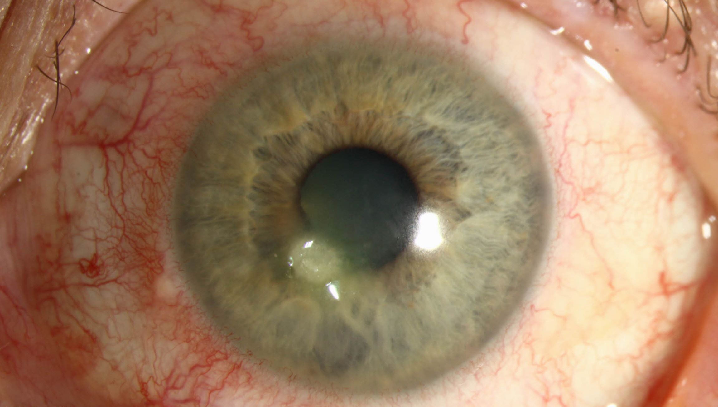 A case of Moraxella keratitis. Authors of this study suggest eyecare practitioners should make contact lens hygiene a priority with patients to help reduce the risk of bacterial keratitis.