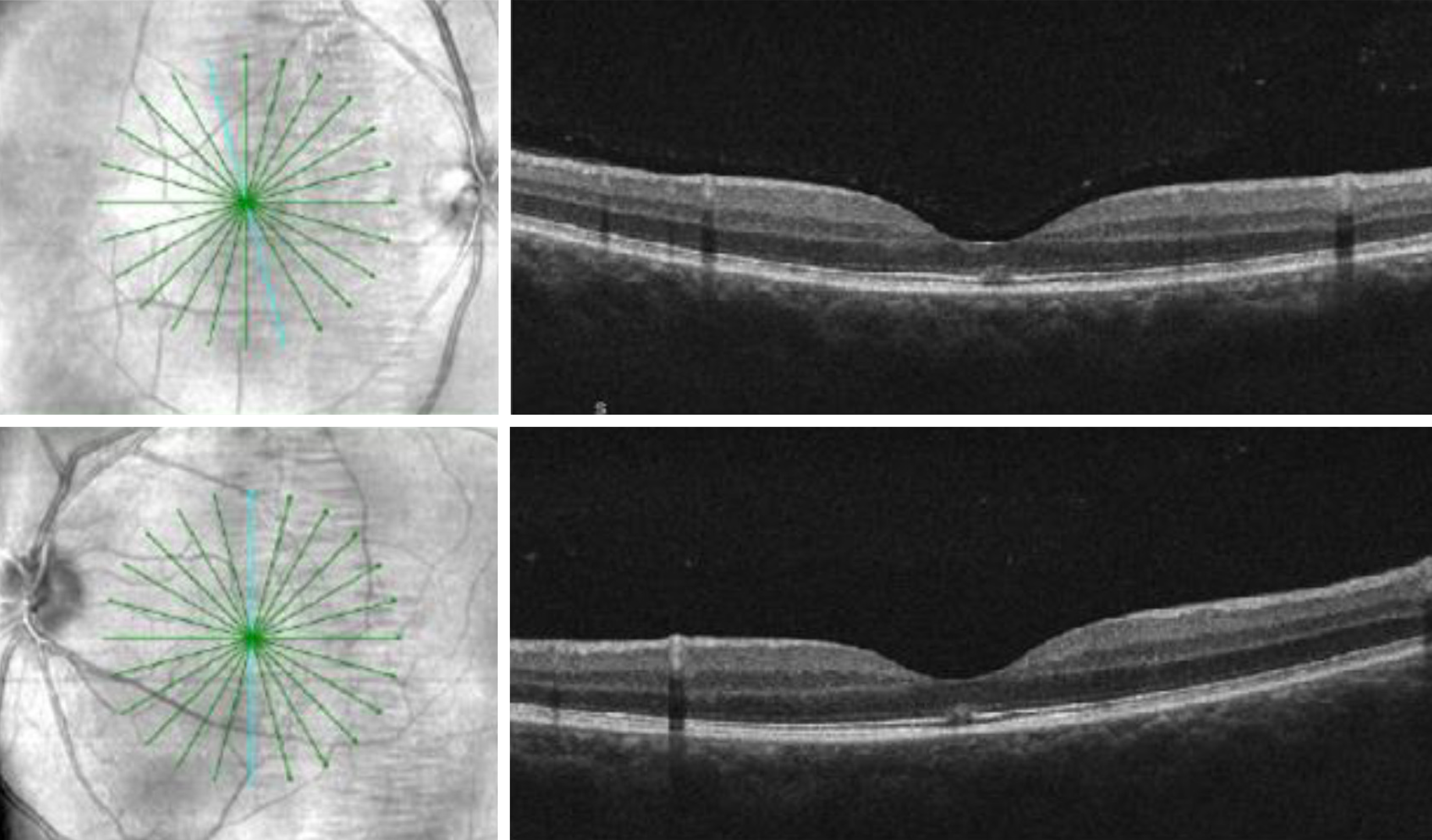 Radial SD-OCT of the bilateral maculae revealed focal disruption of the ellipsoid zone and interdigitation zone at the fovea.