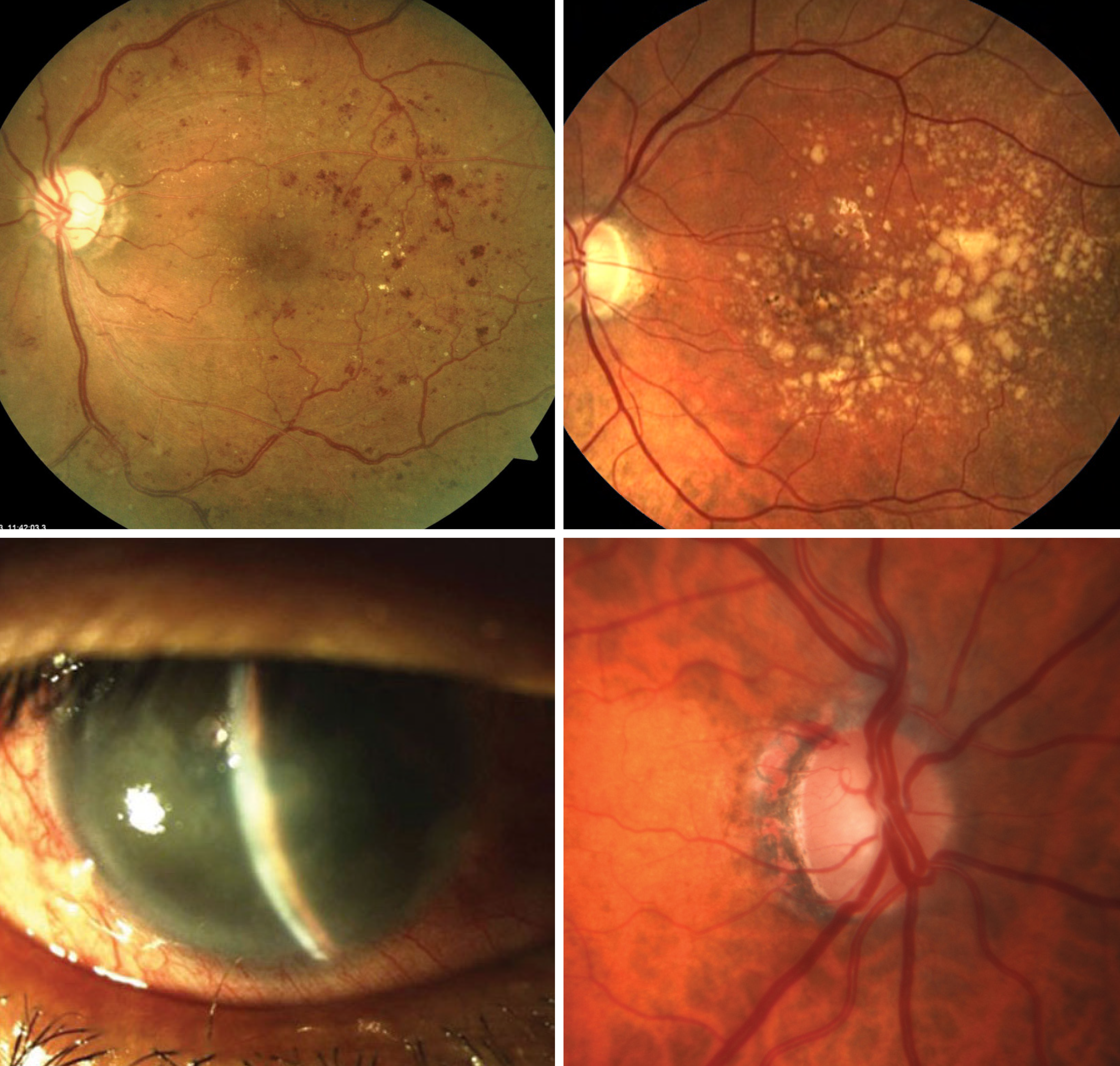 Lengthening of the eye in myopia development confers a protective effect against DR (upper left), AMD (upper right) and angle closure glaucoma (lower left) but elevates risk of open-angle glaucoma (lower right), in addition to increased risk of myopic macular degeneration and non-glaucomatous optic neuropathy.