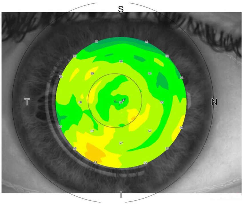 Both corneal and epithelial thickness measurements are important ocular examinations for refractive surgery. Bear in mind that dry eye patients may yield unreliable results due to the influence of an unstable tear film.