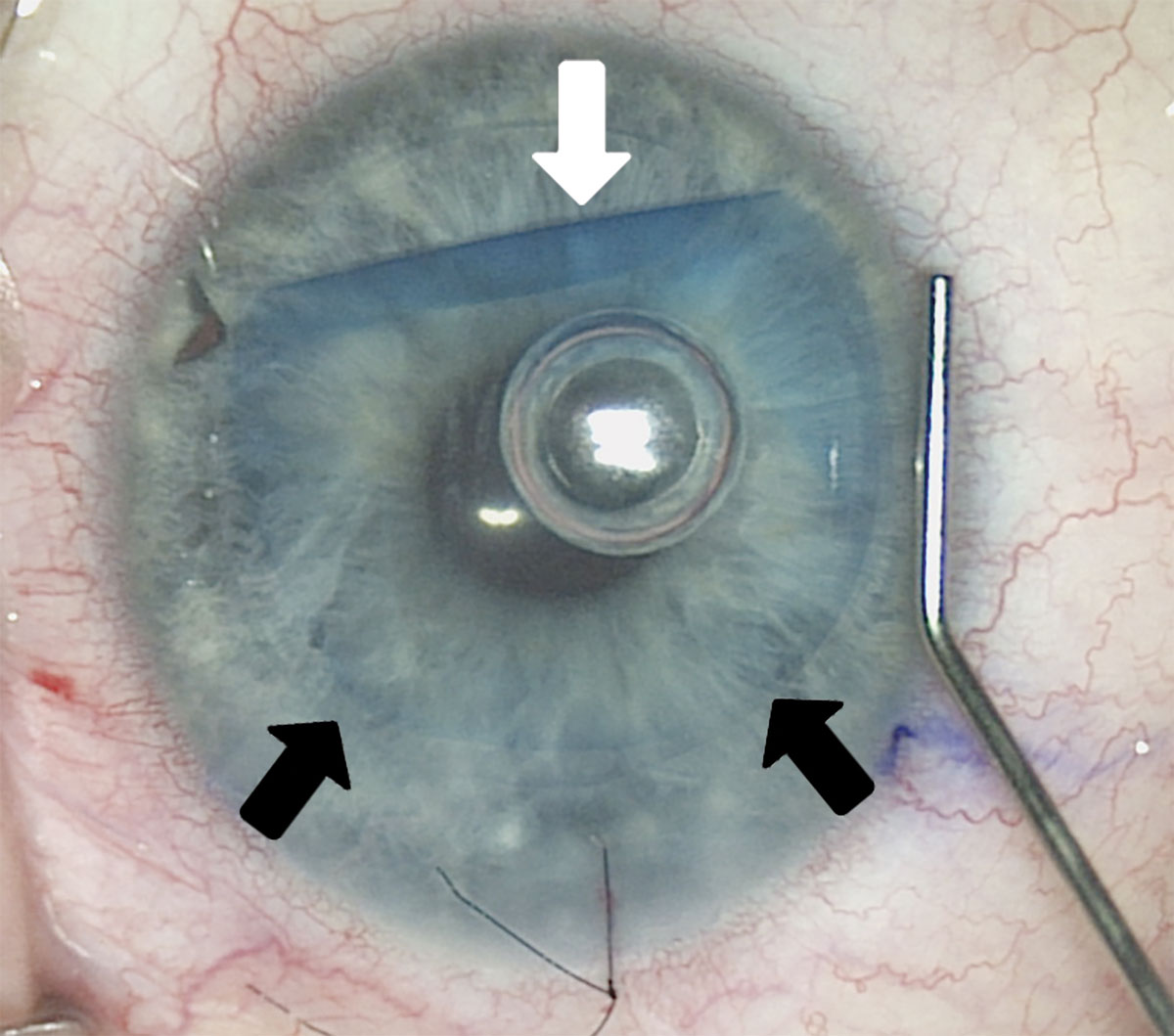 Visual outcomes were comparable for eyes undergoing repeat DMEK for technical failure with controls but were worse for those undergoing the procedure for secondary graft failure. This may be due to a longer duration of corneal edema in these eyes, which would also partially explain higher rates of post-op anterior backscattering when compared with the technical failure eyes.
