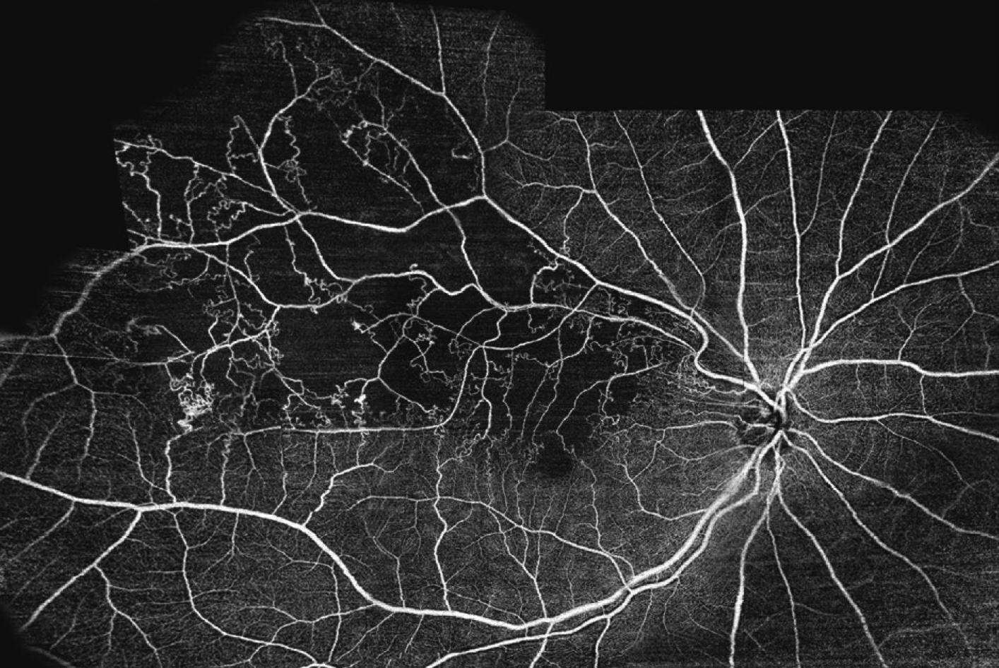 A new study published in the journal Eye quantifies the substantial incidence of a glaucoma diagnosis in patients who previously experienced a retinal vein occlusion. Researchers found that screening tests to confirm open-angle glaucoma were often performed well after the initial RVO diagnosis, or not performed at all, illuminating the risks involved with this delay in care including retinal nerve fiber layer thinning and visual field loss.