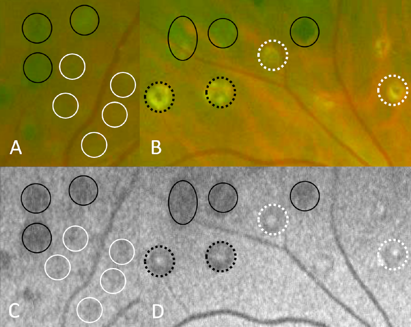 This image from the study shows areas of photocoagulation on fundus photography (A, B) and autofluorescence (C, D). The researchers correlated these areas with microperimetry results and demonstrated some preservation of photoreceptor function. (Black circle: no FAF signal; white circle: lesions with diffuse FAF; white-dotted circle: lesions with white-dotted centers and diffuse FAF in the background; black-dotted circle: lesions with white-dotted centers and no background FAF.)