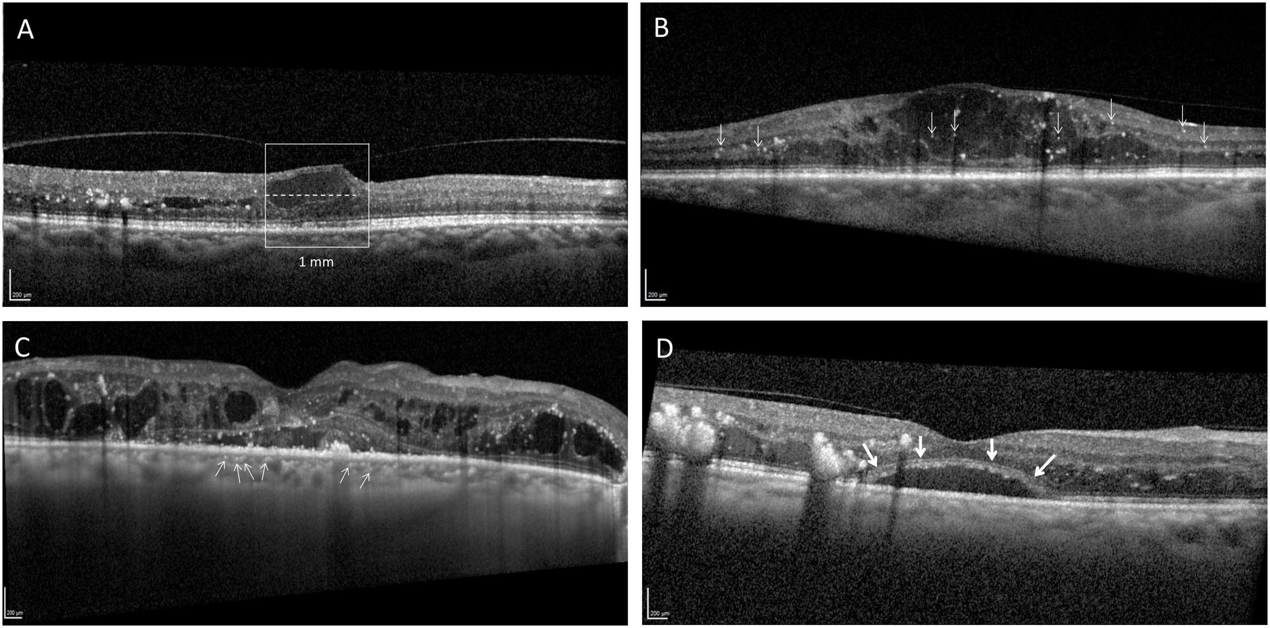 Researchers suggest that male DME patients may require greater vigilance than women, owning to their more inflammatory response to the condition. This image from the study shows several inflammation-related biomarkers with differential findings for men vs. women: (A) disorganization of retinal inner layers (B) retinal hyperreflective foci, (C) hyperreflective choroidal foci and (D) subfoveal neuroretinal detachment.
