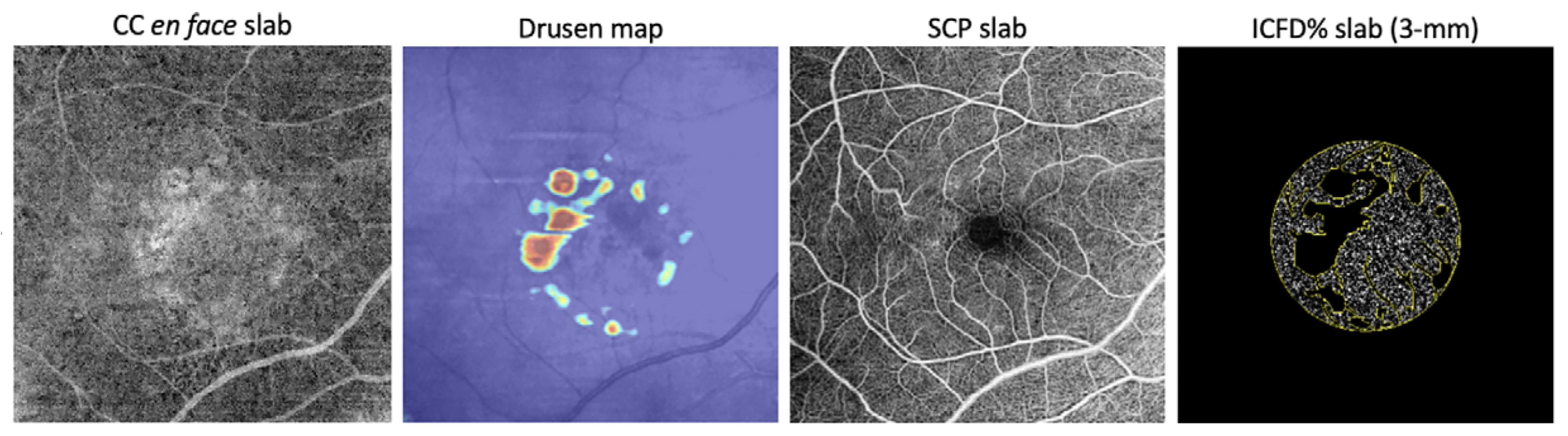 The researchers began with conventional OCT-A imaging of the choriocapillaris, then isolated drusen and the superficial capillary plexus to highlight the structures that might exert a shadowing effect. The IC-FD% was then measured in the central 3mm and 6mm regions. Finally, the team correlated IC-FD% with AMD stage.