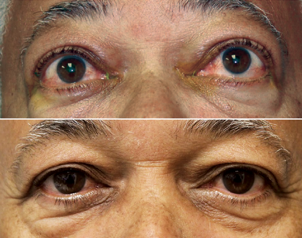 On average, patients with thyroid eye disease who needed more than one course of teprotumumab therapy were seven years older than their non-retreated counterparts (60 vs. 53 years).