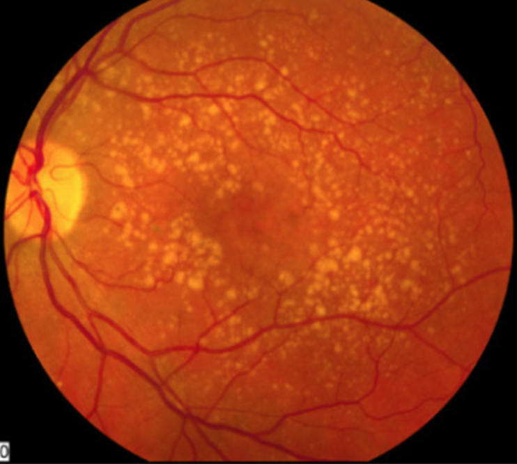 As AMD progresses, patients might experience a shift in the pattern of retinal sensitivity across the visual field potentially linked to structural and functional transformations occurring in the macula.