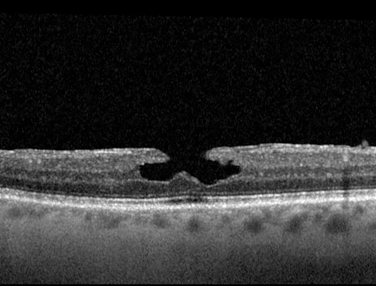 Different Retinal Vascular Changes Seen in Lamellar Macular Hole Subtypes