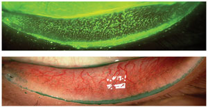 Lid Wiper Epitheliopathy Superior to Corneal, Conjunctival Staining for ...