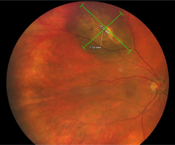 Pigmented tumors had a propensity to occur anterior to the equator whereas non-pigmented tumors tended to occur in the macula to equator region.