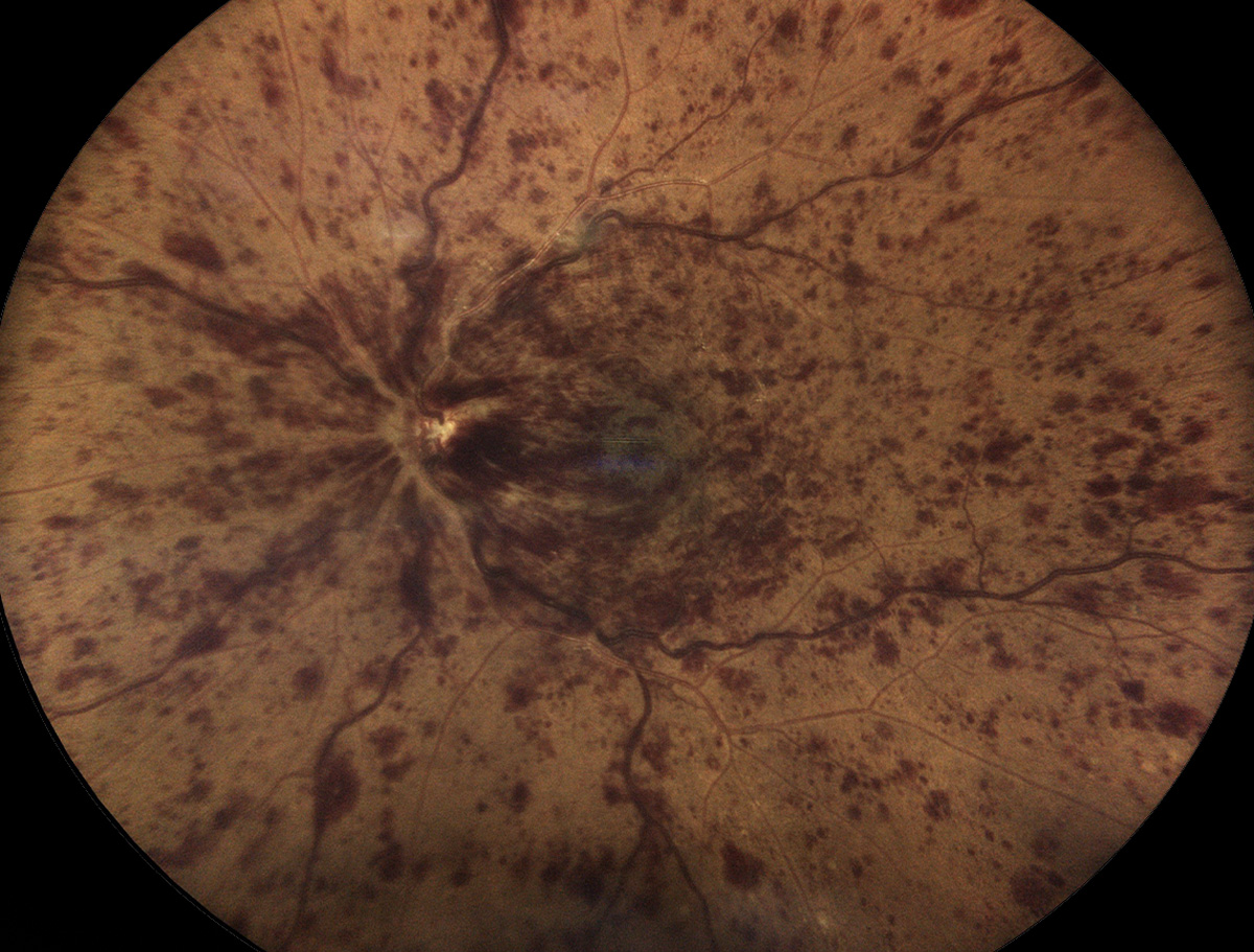 The consistently lower levels in RVO patients across published studies suggest a broad association between vitamin D deficiency and RVO risk. 