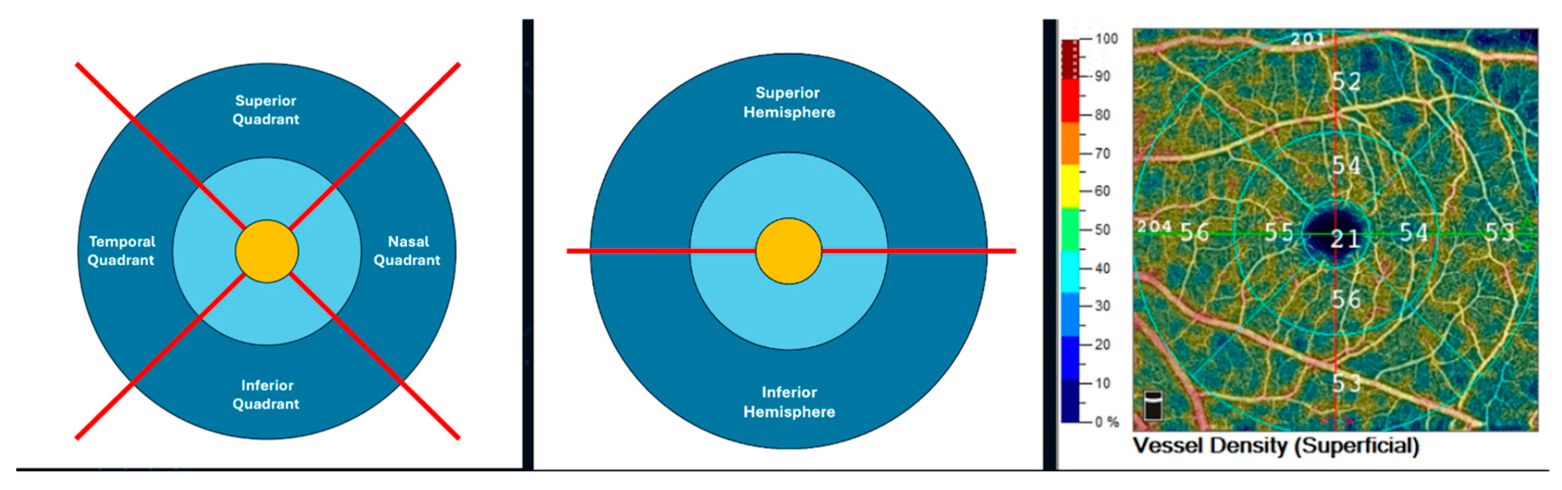 A new study looked at the relationship between global and regional OCT-A- macular biomarkers and their role in early-stage glaucoma detection. It found that superficial capillary plexus vessel density was significantly lower in POAG patients, which correlated to an increasing functional severity based on visual field data. This measure could also be equated with the accuracy of RNFL and GCC thickness in the diagnosis of POAG, wrote the authors.