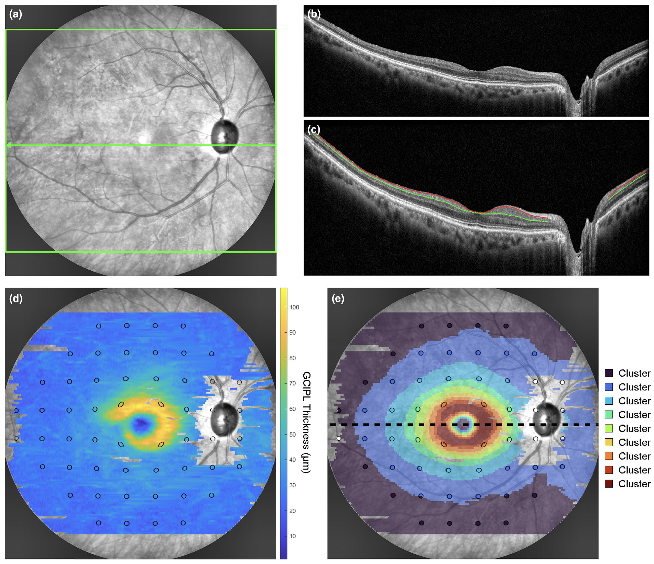 Prediction of VF status based on GCIPL parameters from widefield OCT could become useful to aid clinical decision-making in appropriately targeting VF assessments. This example from the study shows: (a) SLO image with the widefield OCT scan area (green box) and location of the horizontal foveal B-scan (green arrow), (b) the corresponding raw foveal B-scan, (c) the same B-scan with warpage correction applied and segmentation of the RNFL-GC layer (red line) and IPL-INL boundaries (green line) to derive the GCIPL, (d) the GCIPL thickness map across the widefield OCT scan area with 24-2 visual field test locations (black ellipses) superimposed, and (e) the corresponding cluster arrangement describing the spatial pattern of age-related change in GCIPL thickness. 