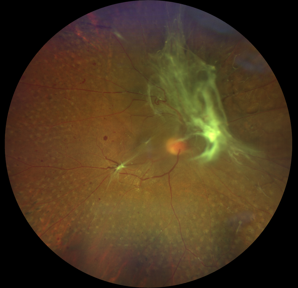 Greater access to routine eye care is unlikely to reduce incidence of corneal abrasion to the same extent as preventable eye emergencies like vitreous hemorrhage, thus making it more important to tackle any barriers to its emergency treatment like limited ED access. 