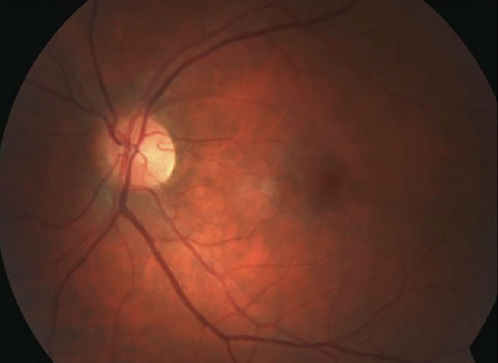 A temporal cilioretinal artery with classic “walking stick” appearance stemming from optic disc.