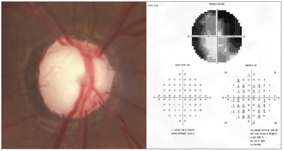 Fig. 1. Cupped out disc in end-stage glaucoma, with corresponding 10º visual field in another patient.