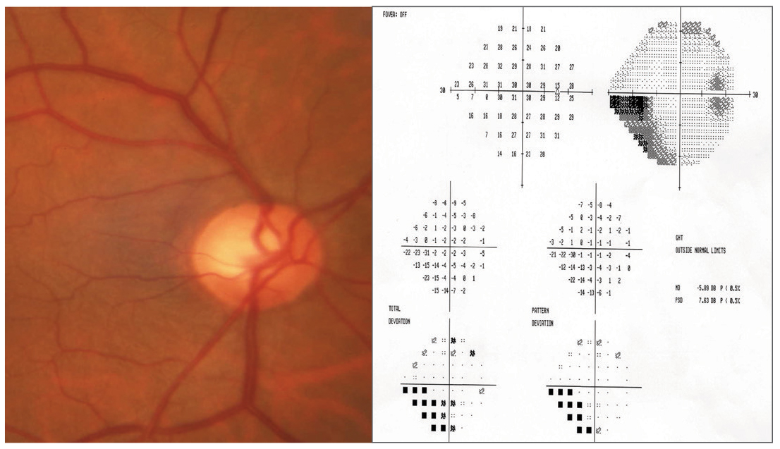 Fig. 2. Cupping in moderate glaucoma in with corresponding 24-2 visual field in another patient.
