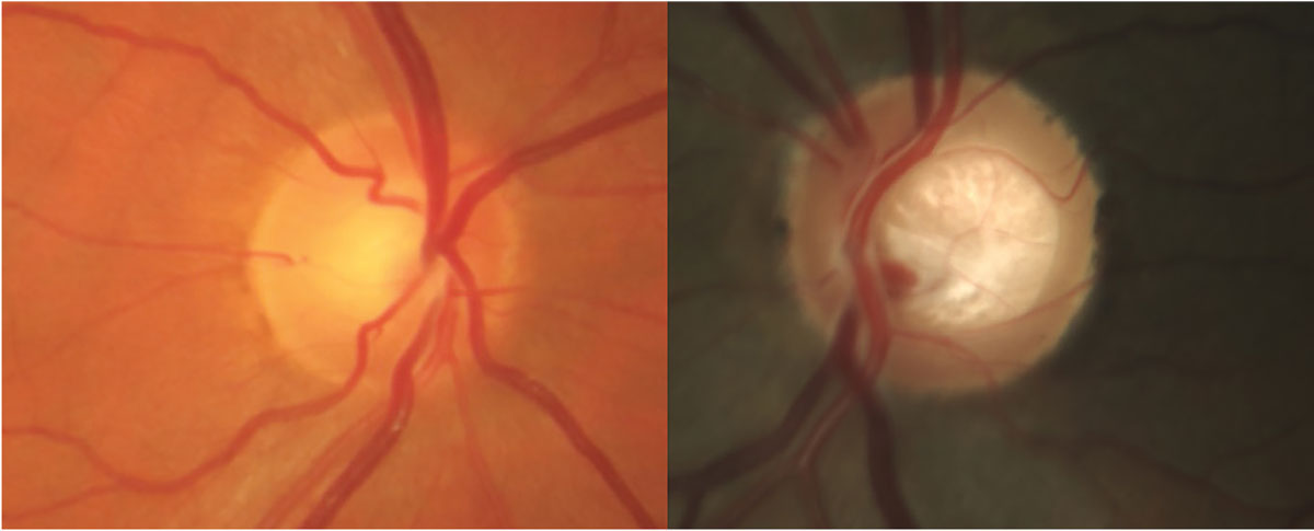Fig. 2. Two patients, both previously labeled as glaucoma suspects. On the left, this patient has IOPs of 26mm Hg OU, central corneal thickness of 523µm and positive family history. Ocular hypertension with GRFs would be a more appropriate classification. On the right, this patient displays laminar distension and questionably thin rim but no other risk factors. FOG with lack of GRFs more accurately depicts this patient’s status.
