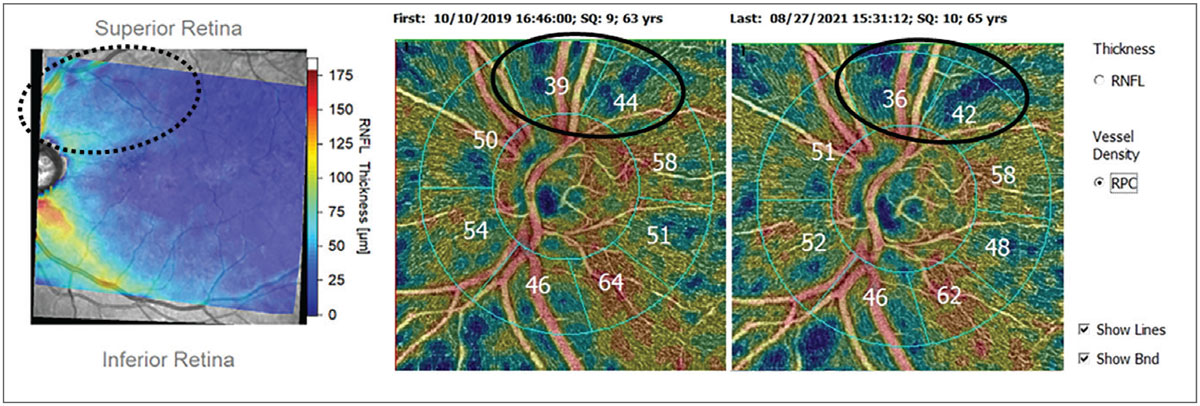 Fig. 3. Patient with glaucomatous damage to the superior arcuate bundle (dotted oval) shown on Hood thickness report (left). OCT-A of circumpapillary vessel density shows corresponding superior loss of vessel density (solid ovals) using OCT-A platform with analytics package and progression software.