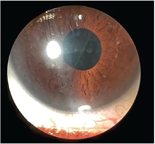 Fig. 4. Durysta sustained-release implant visible in inferior anterior chamber three months post-injection.