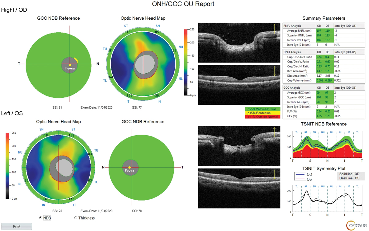 Fig. 6. Thick NFL and GCC with large disc OD and OS.