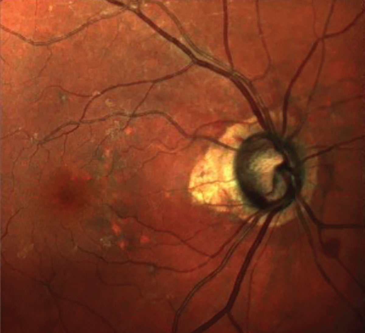 Fig. 1. Seen here is advanced glaucomatous optic neuropathy, peripapillary atrophy, retinal pigment epithelium changes in the macula and a diffuse epiretinal membrane.