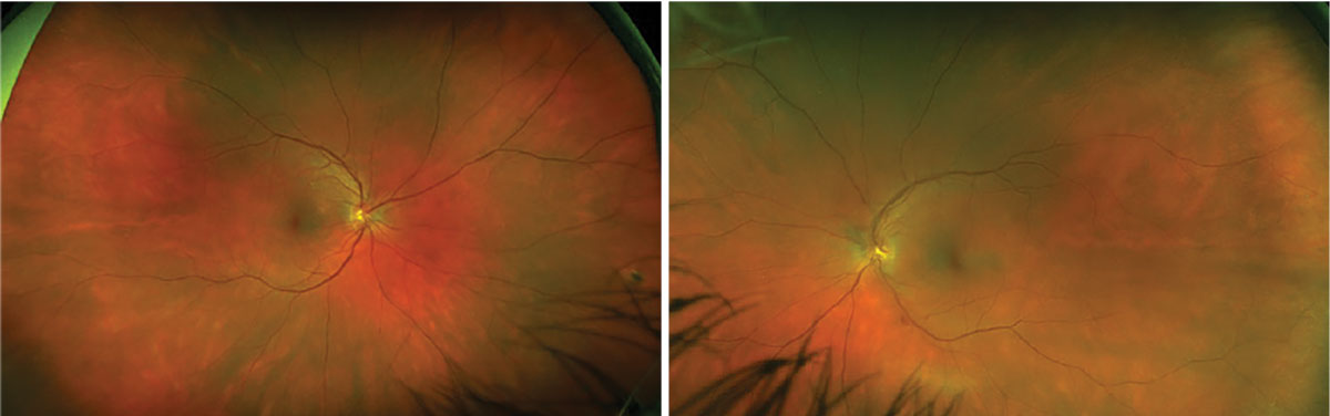 Fig. 1. Optos fundus photo OD (left) and OS (right).