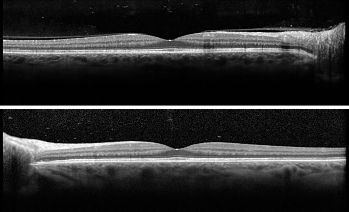Fig. 3. Macular OCT OD (top) and OS (bottom).