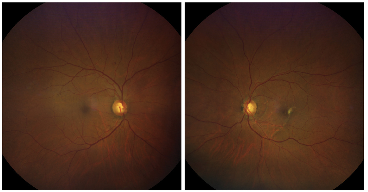 Fundus examination revealed the following presentations. Does this match the case history?
