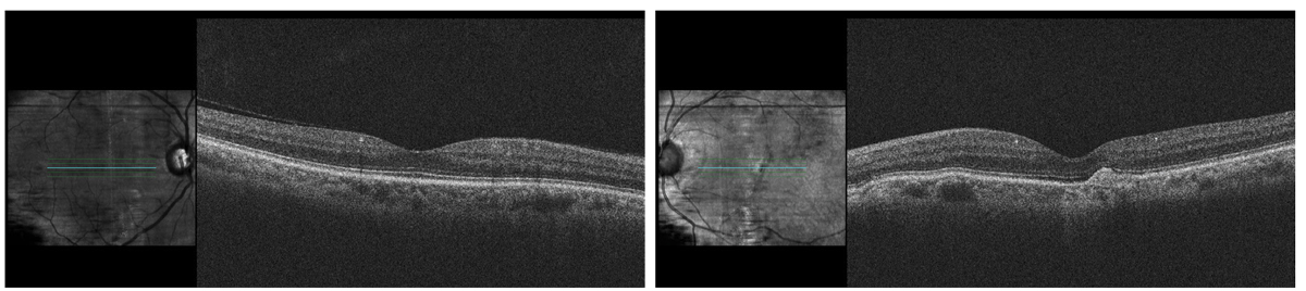 Do the OCT scans seen here give you more information about the patient’s ocular status? Which findings are most pertinent to the case?