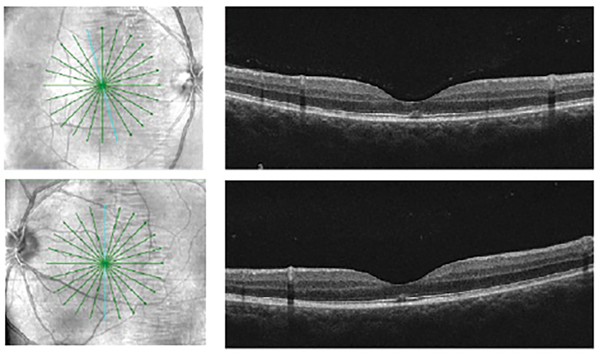 Fig. 1. Cirrus HD Radial SD-OCT of the bilateral maculae revealed focal disruption of the ellipsoid zone and interdigitation zone at the fovea.