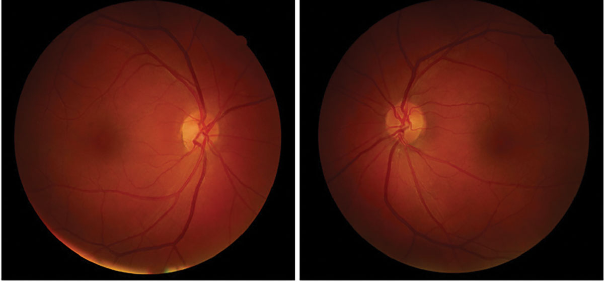 Fig. 2. Fundus photography of the retinas were unremarkable. There was no macular mottling or yellow foveal spot in either eye.