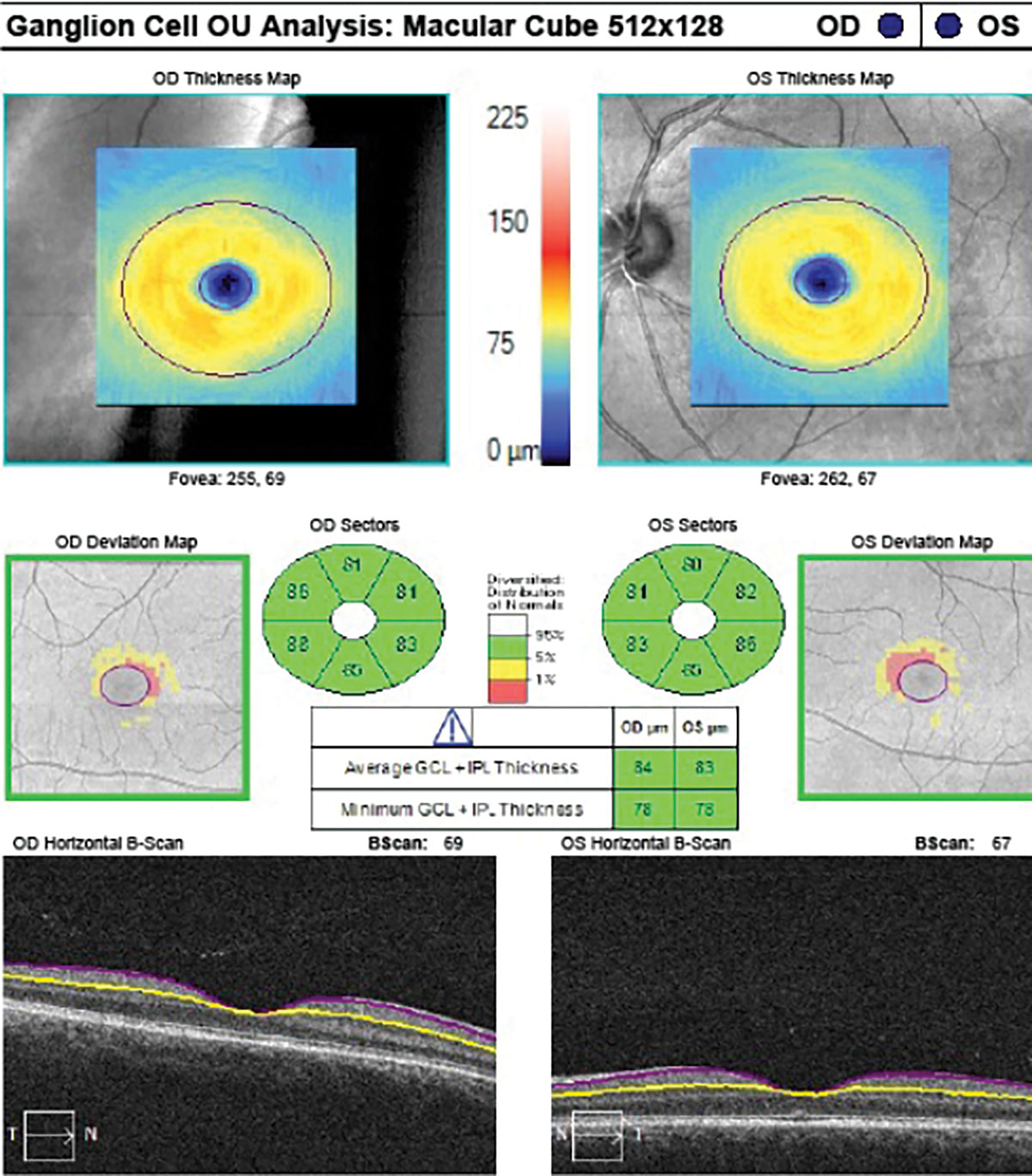 Fig. 3. Cirrus GCC OCT was unremarkable. There was no macular GCC loss in either eye.