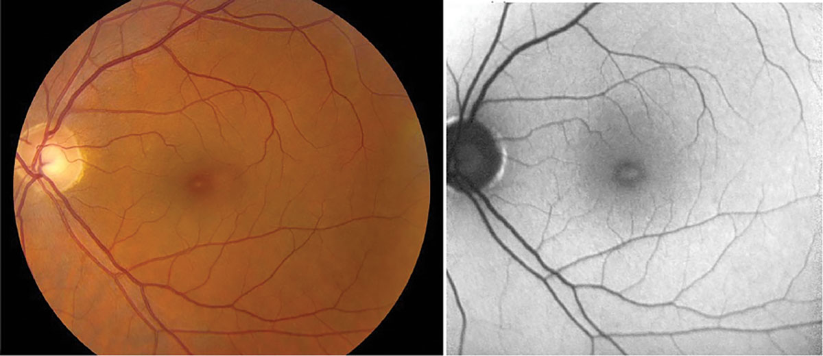Fig. 4. Fundus photo and FAF of a 45-year-old HIV-positive male with visual acuity of 20/30 OU. He reported using poppers regularly for years, with symptomatic onset of central scotoma within 24 hours of last poppers use, and duration of scotoma for seven months. Fundus photo shows yellow spot at the fovea. FAF shows corresponding foveal hyper-autofluorescence.