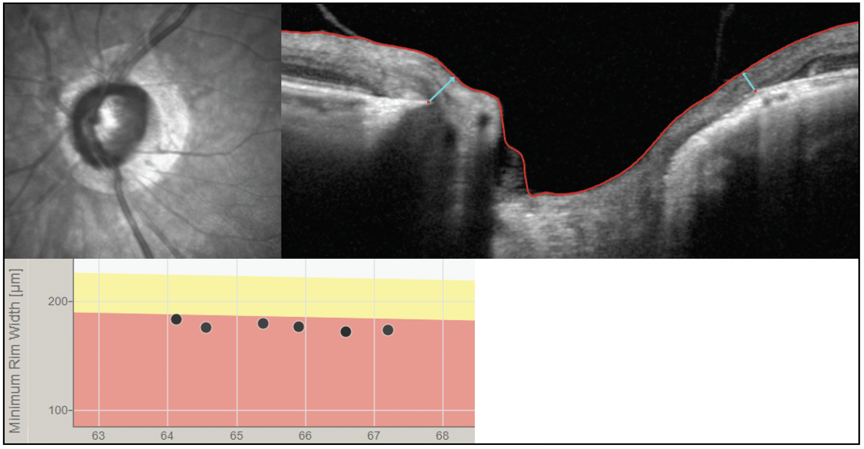 Increasingly sophisticated technologies are giving optometrists more precise information on their glaucoma patients’ disease status. For instance, the BMO-MRW image above (light blue arrows) may be a better way to track progression than the RNFL in high myopes who are suspected of having glaucoma or in those with confirmed myopic glaucoma. These new tools both improve ODs’ management of the condition and add to the slate of clinical responsibilities one must be able to perform or refer out to another provider for. 