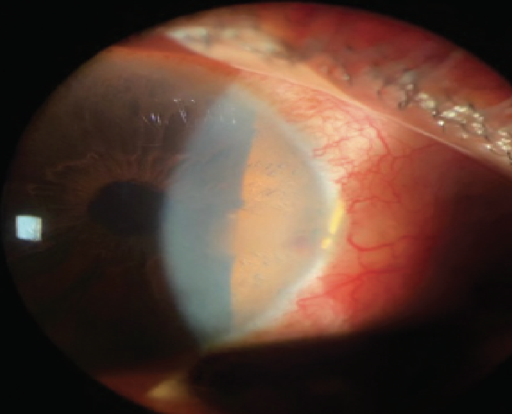This patient has a more translucent limbus where the Hydrus Microstent is visible on slit lamp within the nasal angle. This should not be a cause for alarm. Of note, observe the significant conjunctival injection and faint hyphema at the stent opening, which warrants a topical steroid to control the inflammation. 