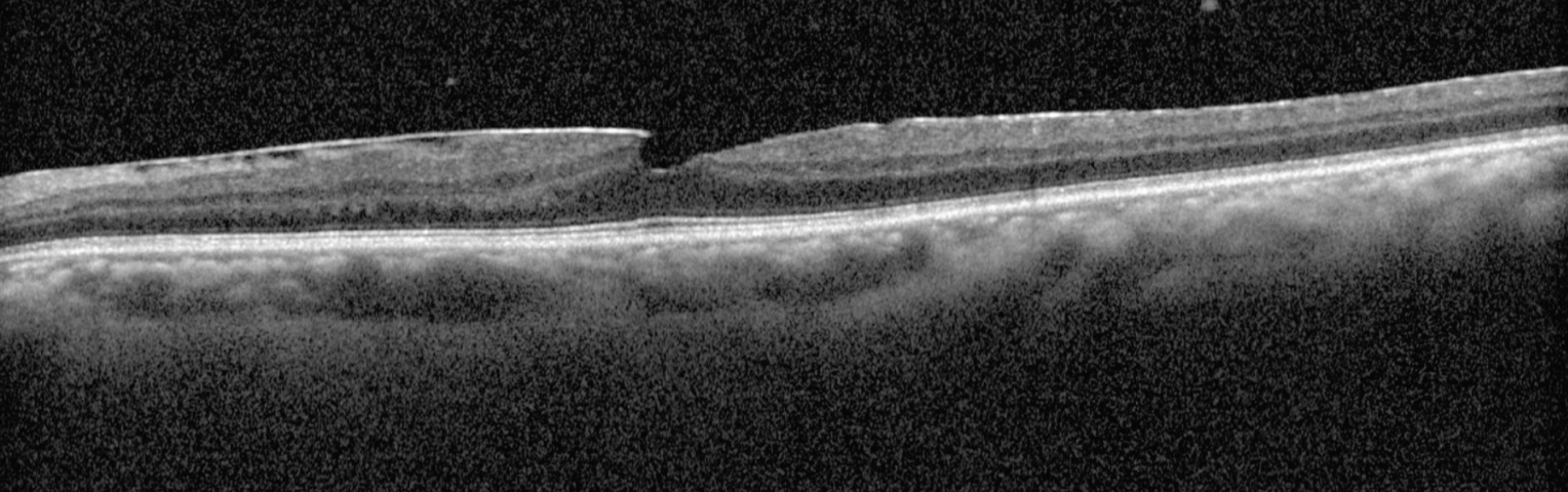 Fig. 3. An OCT scan of the left eye reveals notable vitreous inflammatory cells, an epiretinal membrane and a pseudohole.