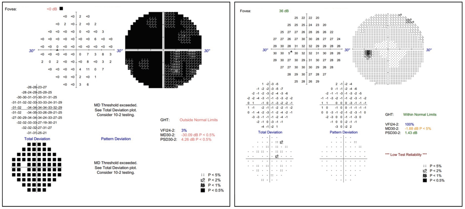 Fig. 4. Visual field of the left eye at initial presentation (left) vs. post-systemic treatment (right). 