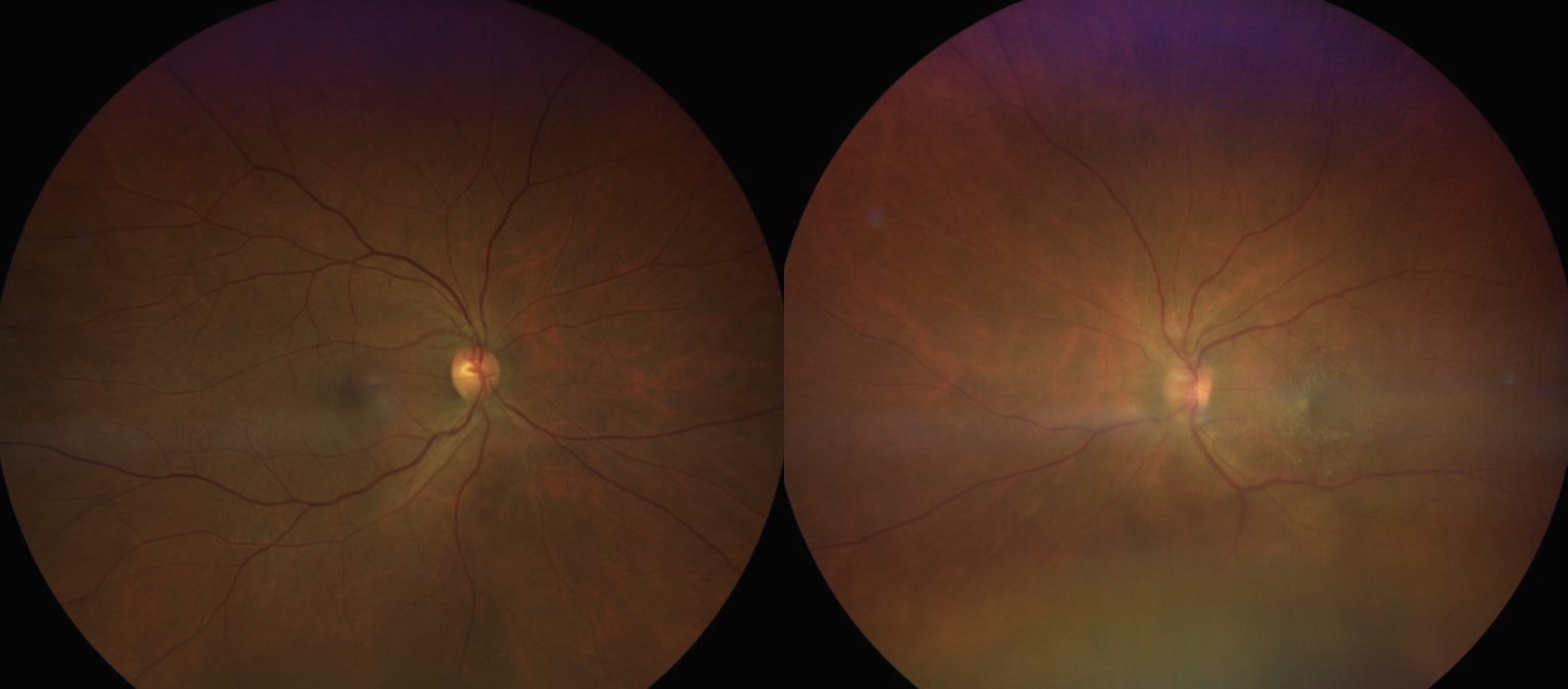 Fig. 2. In these fundus photos, the right eye (left image) appears unremarkable, while the left eye (right image) shows a hazy view with disc edema and an epiretinal membrane.