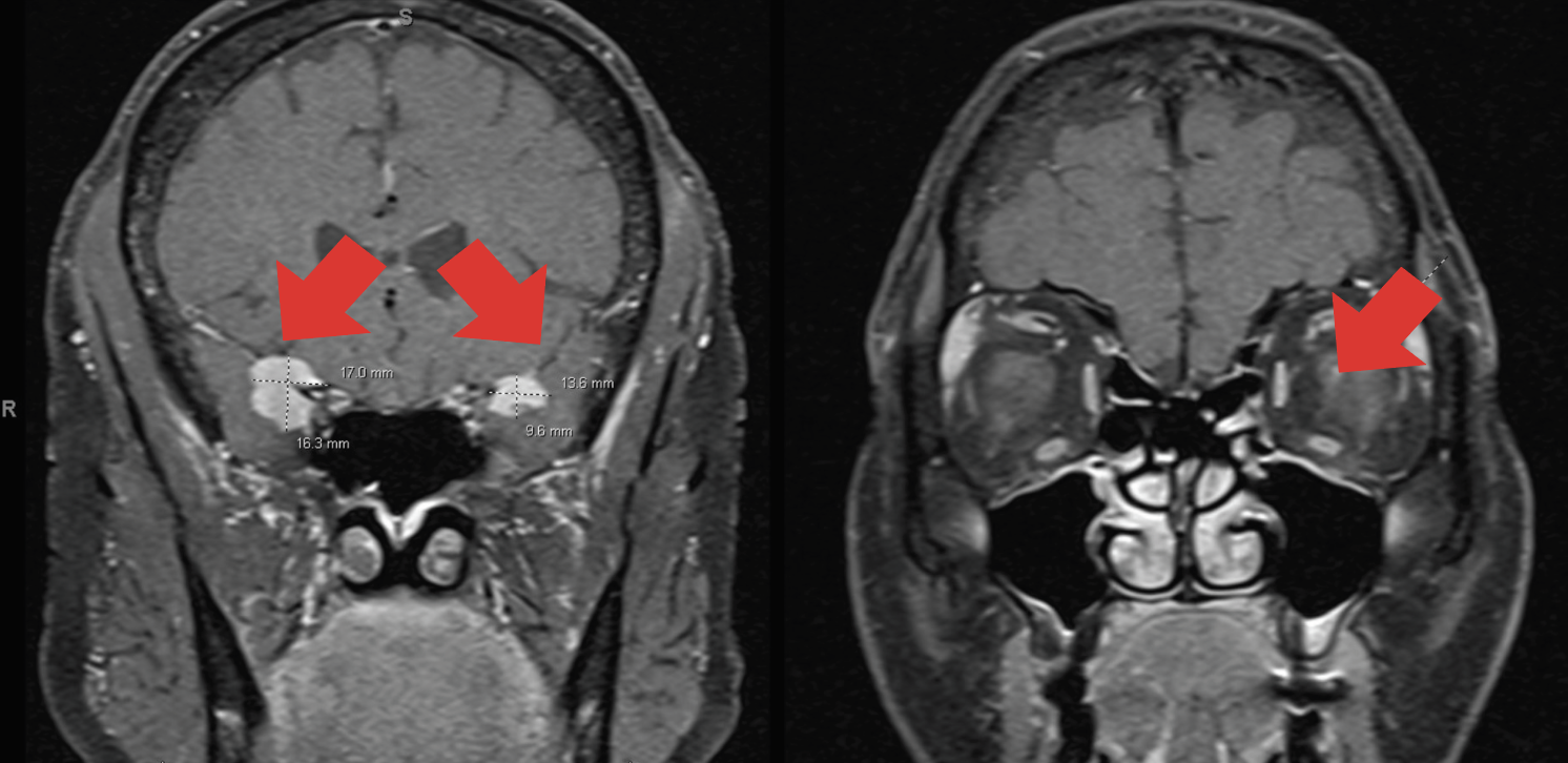 Fig. 1. Nodular mass-like extra-axial enhancement in the bilateral middle cranial fossa, centered about the clinoid processes. There is also focal enhancement of the left optic disc. 
