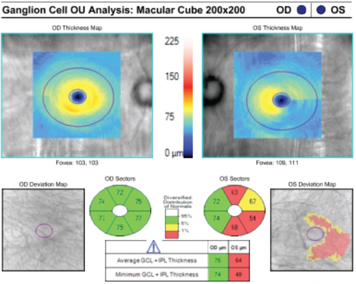 Macular ganglion cell analysis can be a screening tool that can discern glaucoma patients from glaucoma suspects.