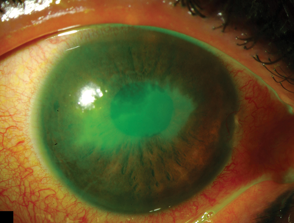 In patients with ocular graft vs. host disease, researchers found corneal sensitivity loss to be associated with reduced main trunk, branch and total nerve density.