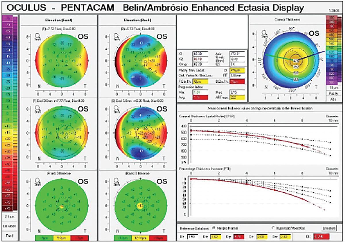 ABCD Keratoconus Grading System Effective in Measuring CXL Response