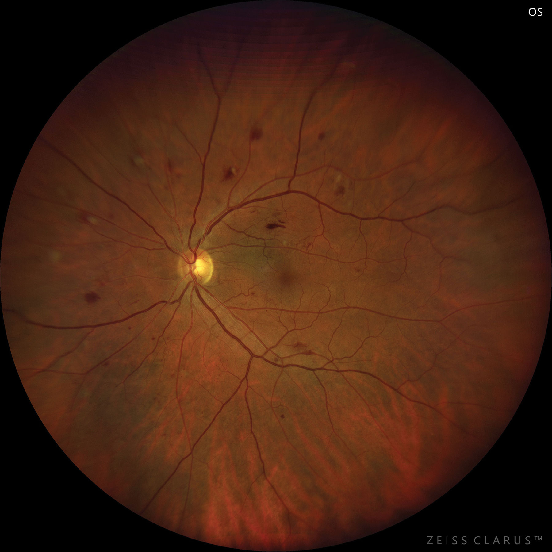 Researchers believe that the observed decline in DR screenings of established patients post-COVID-19 may be due to a change in patient mentality and/or a shift in the priorities of healthcare providers. 