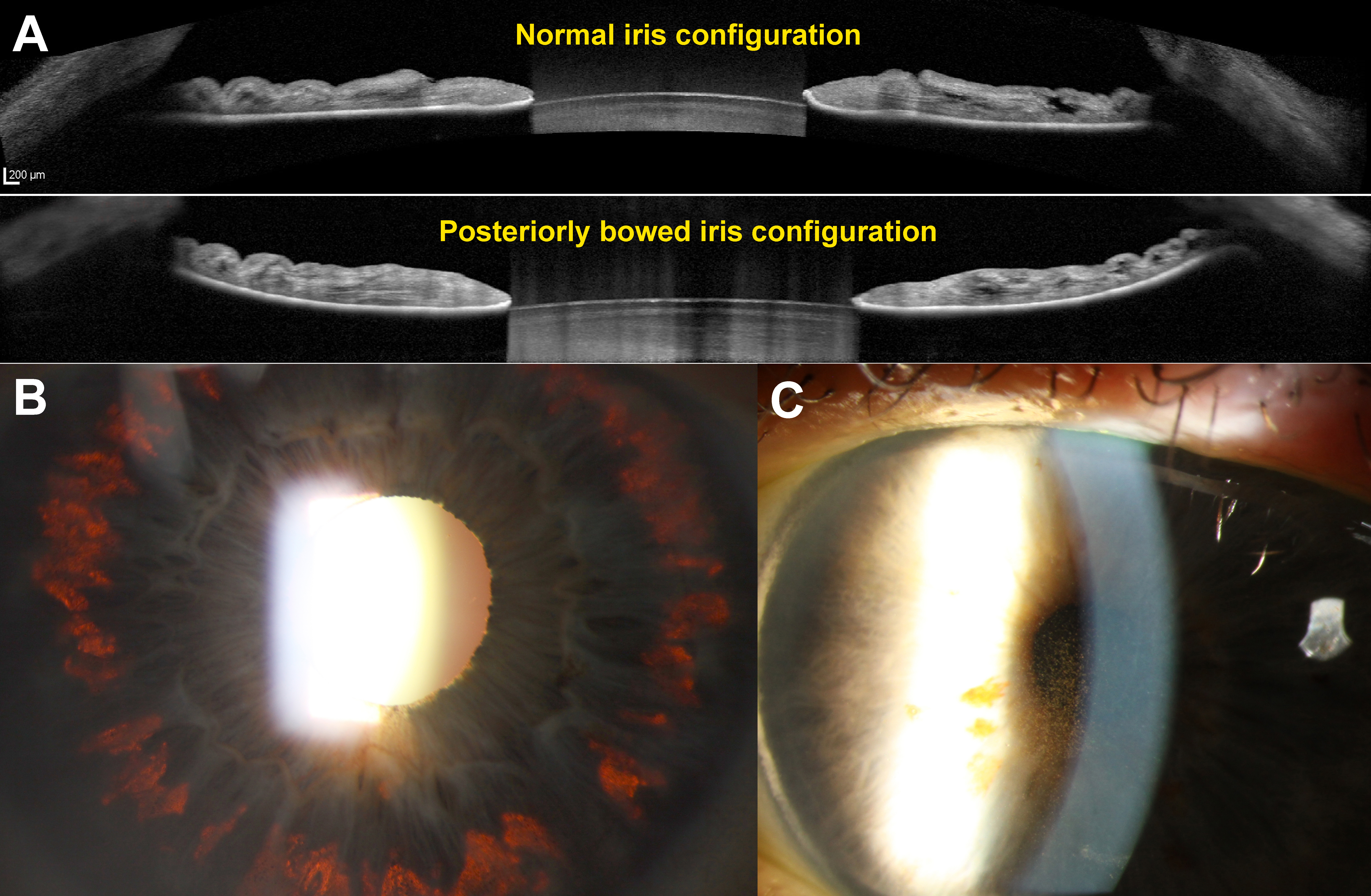 This study identified a seven-fold increase in risk of pigmentary iris degeneration and a four-fold increase in likelihood of pigmentary glaucoma in patients on topical moxifloxacin.