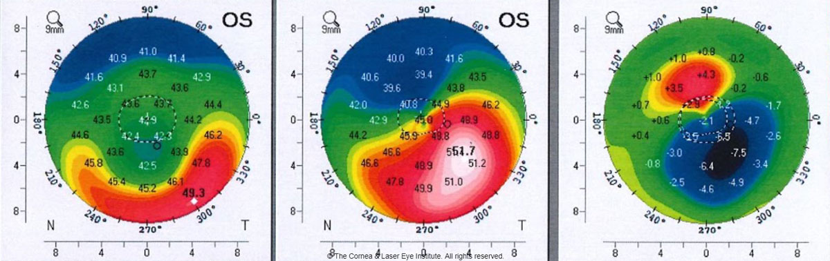 Even stable patients with stiffer corneas experienced a marked improvement in visual outcomes and corneal regularization after combined use of both procedures. 