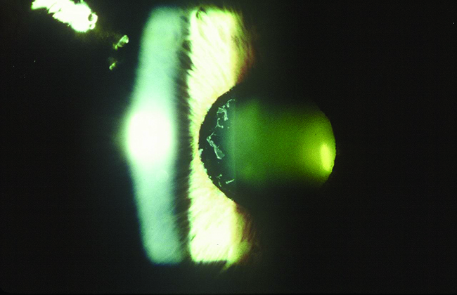 In non-glaucomatous XFS, the vascular supply defect plays a more critical role than intraocular pressure. However, with other forms of the pseudoexfoliation spectrum, intraocular pressure adds to risk factors of damage. 